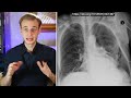 10 MUST KNOW Chest X-Rays For Medical/PA Finals | CXRs Made Easy