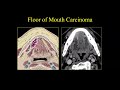 Suresh Mukherji.  Lymph Nodes of the Head & Neck