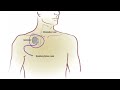 Excess Deaths at Night - Obstructive Sleep Apnea Explained Clearly