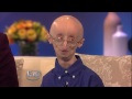 16-year-old with Progeria An Inspiration to All