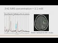 Imaging Diagnosis of CNS Tumors in Context of the New 2021 WHO Classification