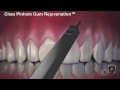 The Difference Between Gum Grafting and Chao Pinhole Surgical Technique