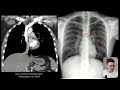 Chest X-ray Anatomy | Radiology anatomy part 1 prep | How to interpret a chest X-ray