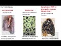 PNEUMOCONIOSIS Part 1: Pathogenesis, Coal workers pneumoconiosis