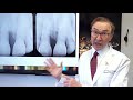 AMAZING Results With LANAP | Gum Disease Treatment