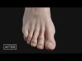 Minimally Invasive Hallux Valgus Bunion Surgery